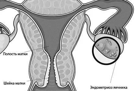 лікувати ендометріоїдних кісти