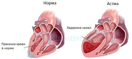 як лікувати серцеву астму народними засобами