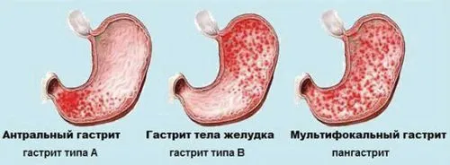 лікування