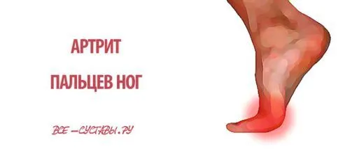 артрит суглобів пальців ніг симптоми лікування