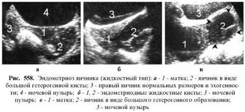 лікувати ендометріоїдних кісти