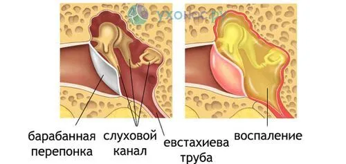 лікувати грибковий отит
