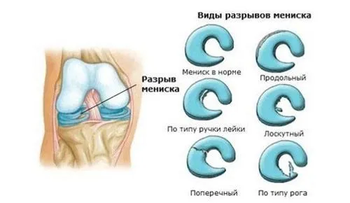 чи можна вилікувати меніск без операції