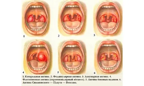 як лікувати тонзиліт дитині 3 роки