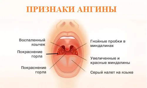 як лікувати тонзиліт дитині 3 роки