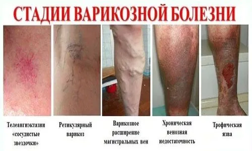 як лікувати варикоз господарським милом