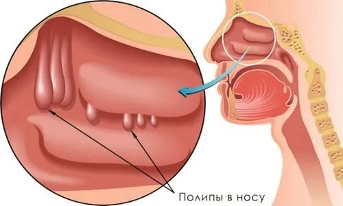 хронічний гайморит грибкової етіології