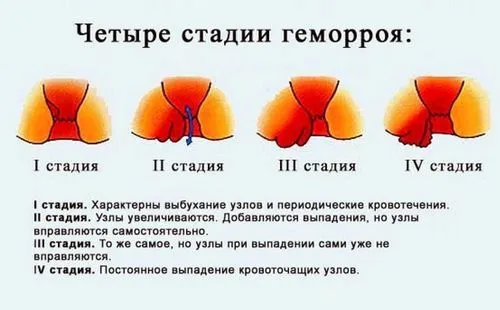 як лікувати геморой третьої стадії