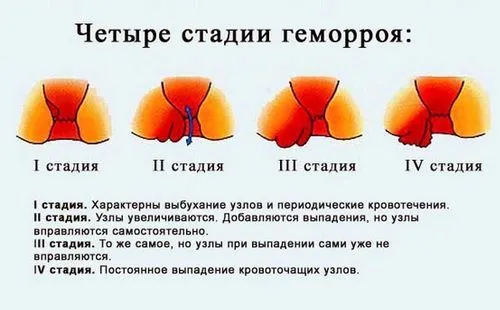 як лікувати геморой третьої стадії
