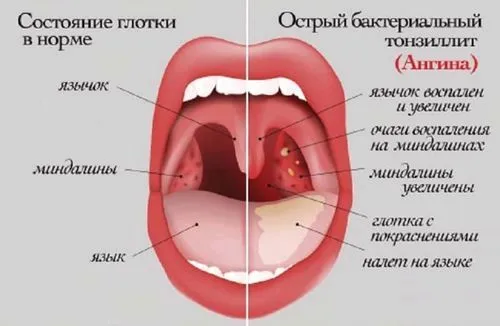 як лікувати мигдалини горла