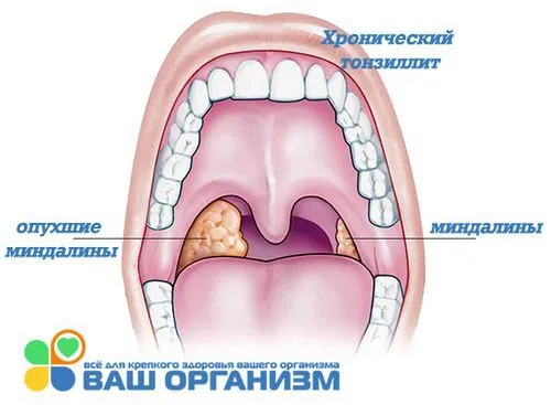 як лікувати алергічний тонзиліт