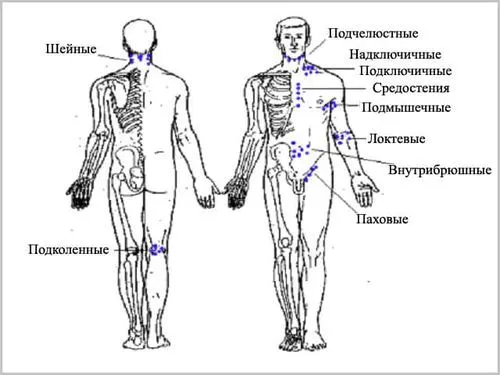 паховий лімфаденіт чоловіки запалення лімфовузол пах збільшення лікування