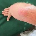 артрит кистей рук