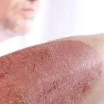 як лікувати псоріаз рук