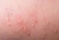 як лікувати алергію содою