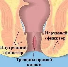 тріщина прямої кишки народні засоби