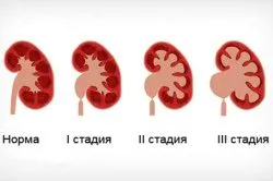 болять нирки температура 37
