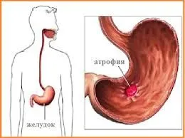 лікувати атрофічний гастрит