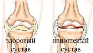 як лікувати остеохондроз коліна