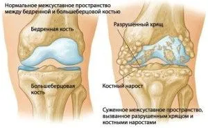як лікувати остеохондроз коліна