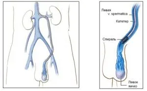 чи можна лікувати безпліддя після варикоцеле
