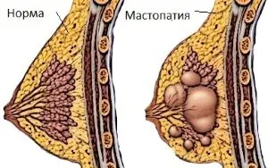 як лікувати фіброзну кісту