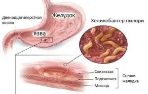 лікувати атрофічний гастрит