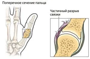 як лікувати розтягнення великого пальця руки