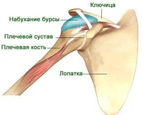 субакроміальний бурсит плечового суглоба лікування