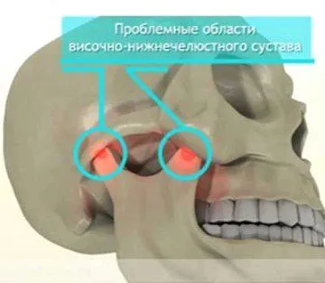 забій щелепи