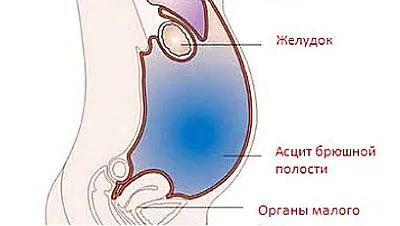 Стадії цирозу печінки (з 1 по 4) як лікувати цироз печінки 4 стадії