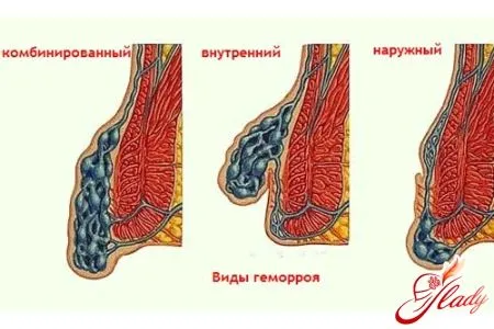лікувати геморой медикаментами