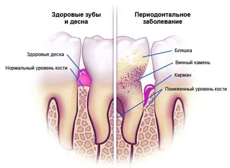 як лікують ясна маслом обліпихи