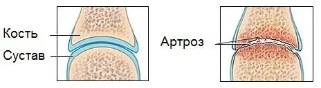 як лікувати артроз травами