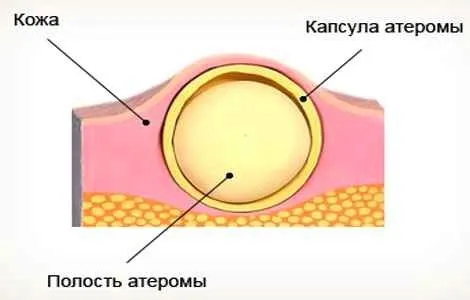 як лікувати жировик на мочці вуха