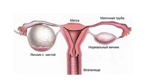 лікування ендометріоїдних кісти яєчника