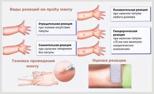 Ознаки туберкульозу у дітей як правильно лікувати туберкульоз у дітей