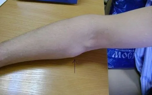 як лікувати жировик на руці