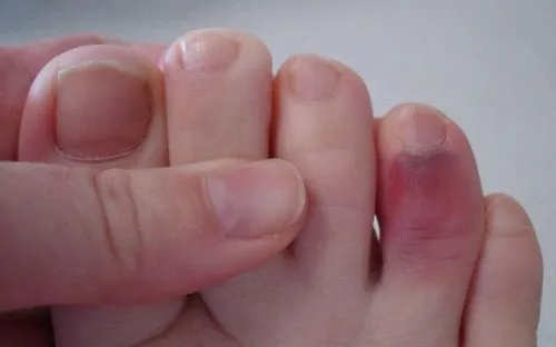 швидко лікувати забій пальця ноги