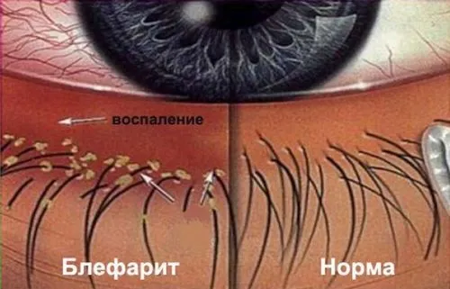 блефарит запалення ока зір причини симптоми лускатий виразковий мейбоміевий рожеві демодекозне діагностика лікування народна медицина