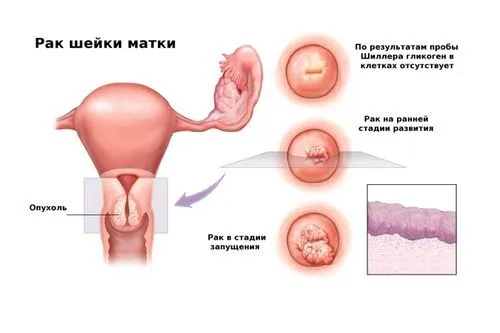 як лікувати папіломи у вагітних