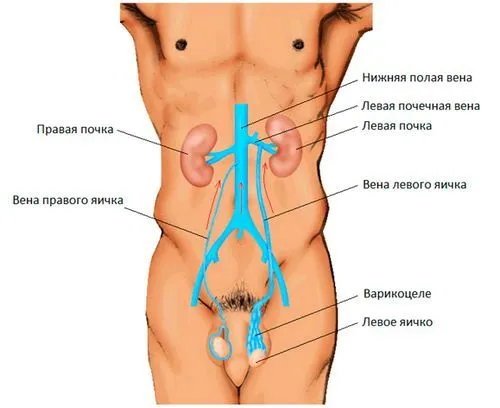 чи можна лікувати безпліддя після варикоцеле