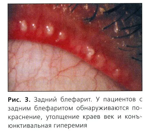 блефарит