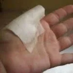 як швидко вилікувати забій пальця