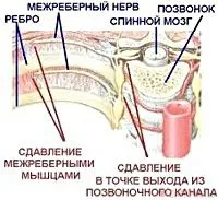 як лікувати невралгію ребер