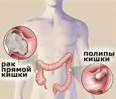 якщо не лікувати рак прямої кишки