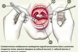 як лікувати хронічний фарингіт у дорослих