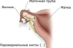 Параовариальная кіста: симптоми і причини про кісту