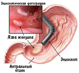 як лікувати виразку шлунка і дванадцятипалої кишки