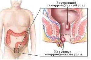 як вилікувати геморой сіллю